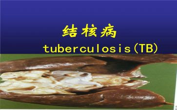 结核病日心得体会7篇